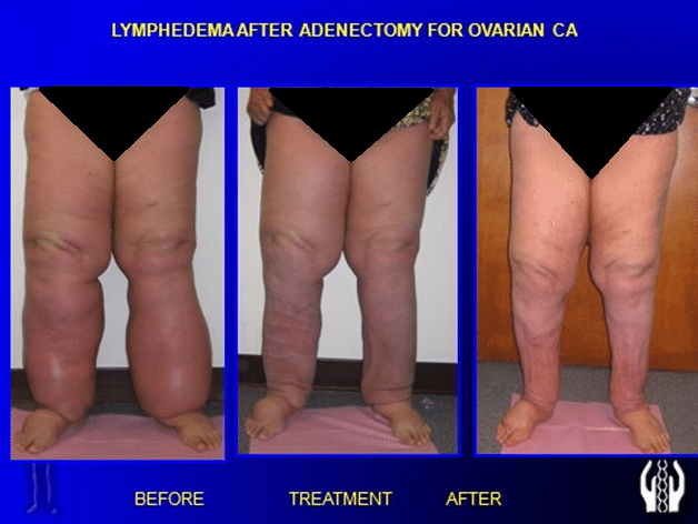Before and After Image: Lymphedema - front