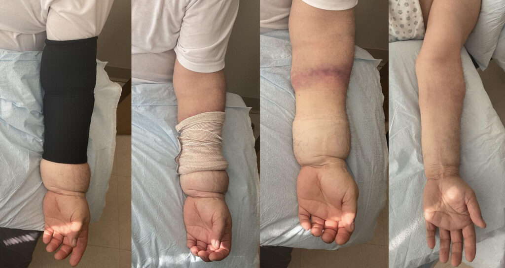 Before and After Image: Improper Lymphedema Self-bandaging - front