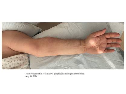 After Image: Improper Lymphedema Self-bandaging - front