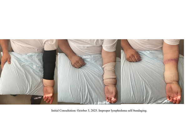 Before Image: Improper Lymphedema Self-bandaging - front