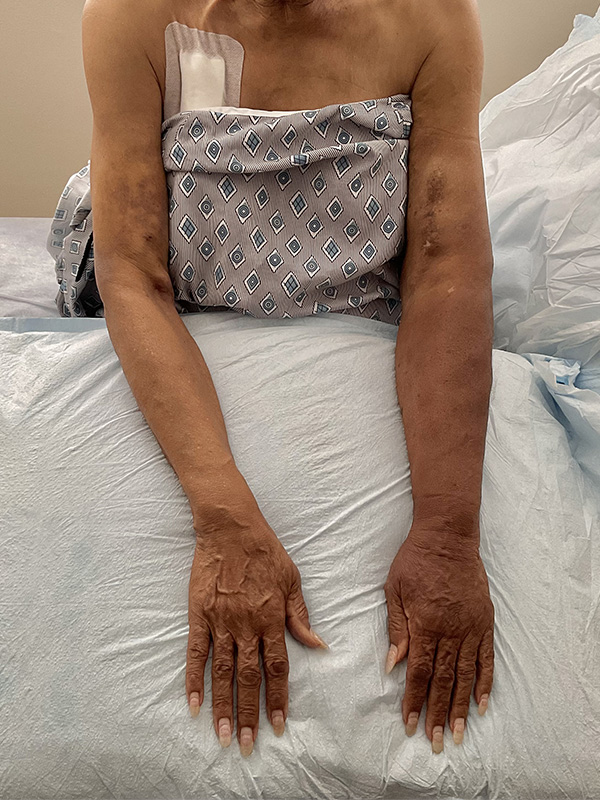 After Image: Lymphedema - front