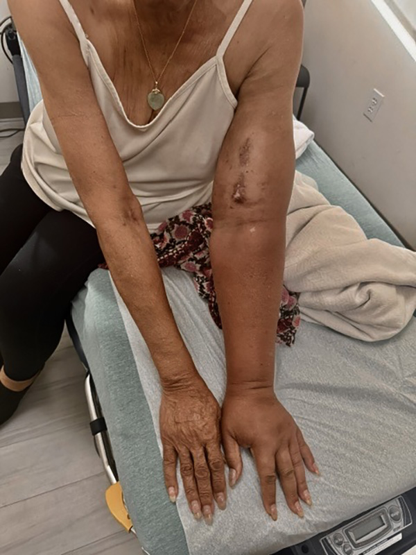 Before Image: Lymphedema - front