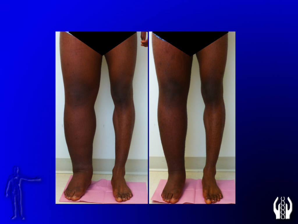 Before and After Image: Lymphedema - front