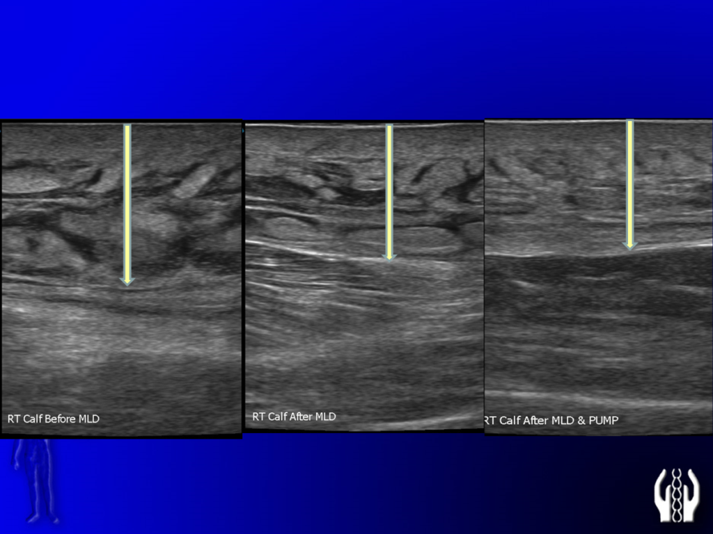 Before and After Image: Lymphedema Ultrasound: Before and After Treatment - front