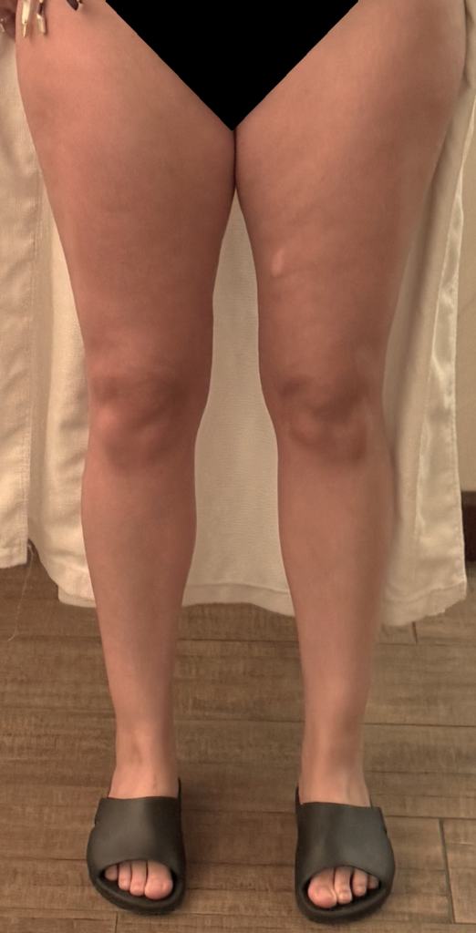 Before Image: Lipedema Stage I: Before and After Conservative Management Treatment - front