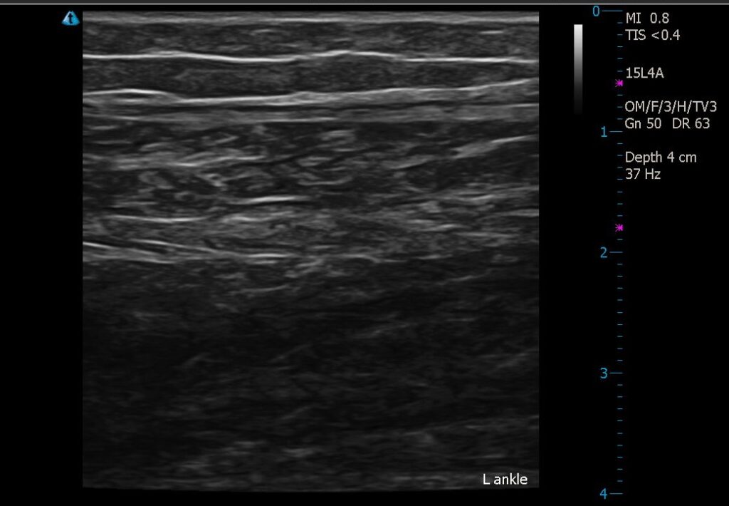After Image: Lipedema Stage I Ultrasound Before and After 16 Months Conservative Management - front
