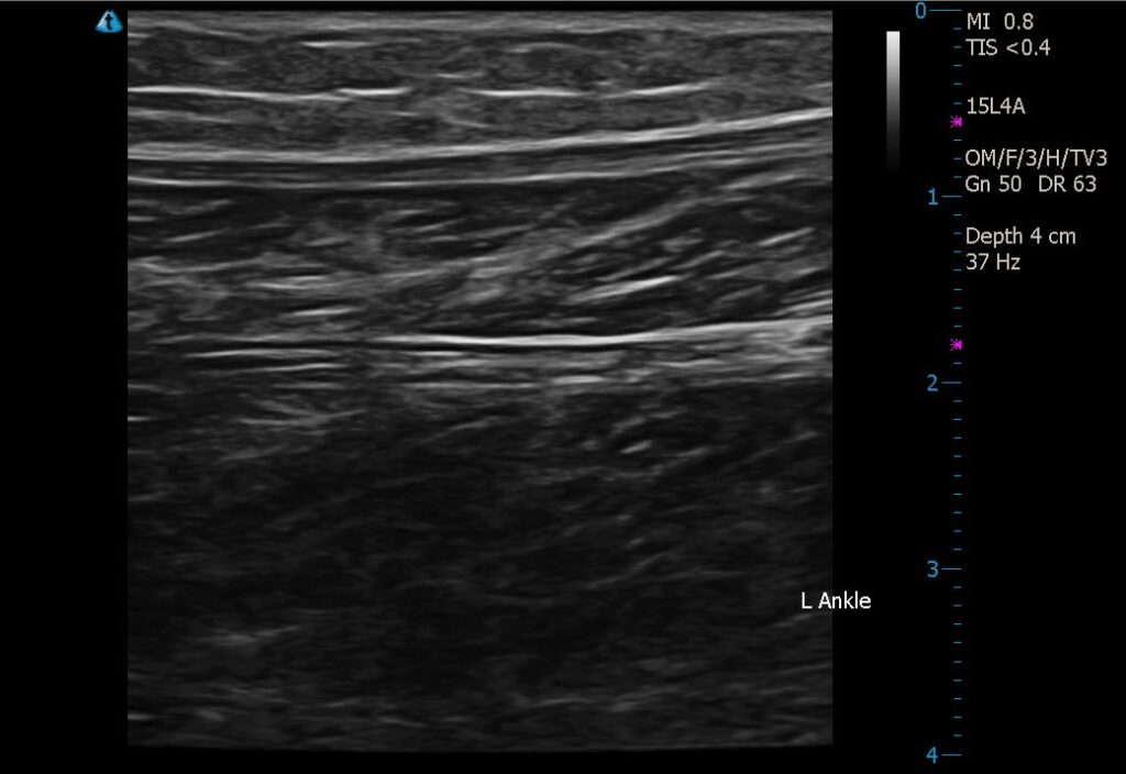 Before Image: Lipedema Stage I Ultrasound Before and After 16 Months Conservative Management - front