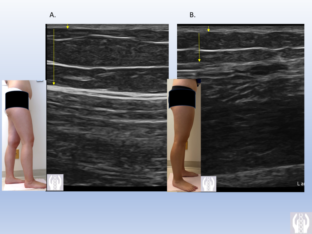 Before and After Image: Lipedema Ultrasound - front